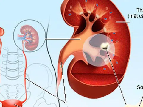 Nhắc bạn những điều quan trọng giúp thận khoẻ, tránh được các bệnh nguy hiểm